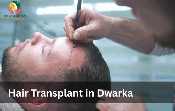 Hair Transplant in Dwarka