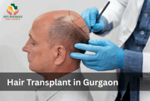 Hair Transplant in Gurgaon
