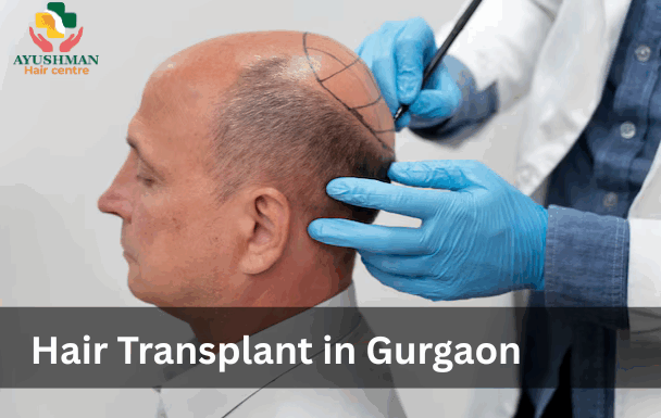 Hair Transplant in Gurgaon