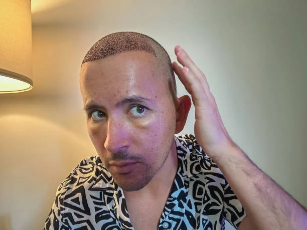 Unshaven Hair Transplant