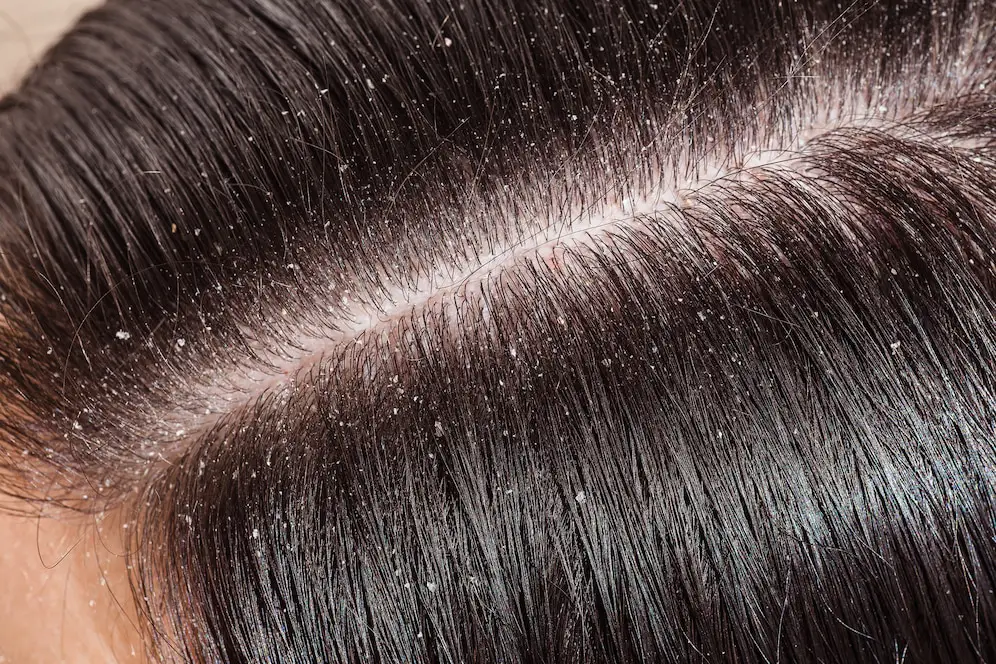 Hair Dandruff Treatment in Delhi