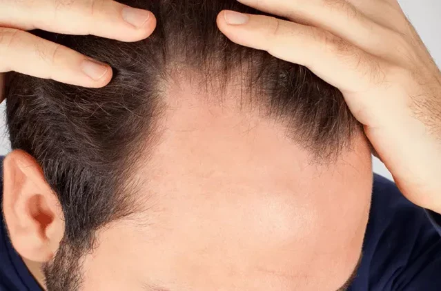 Temple Hair Transplant