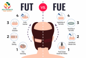 FUE vs FUT Hair Transplant