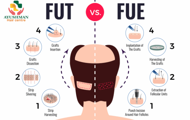FUE vs FUT Hair Transplant