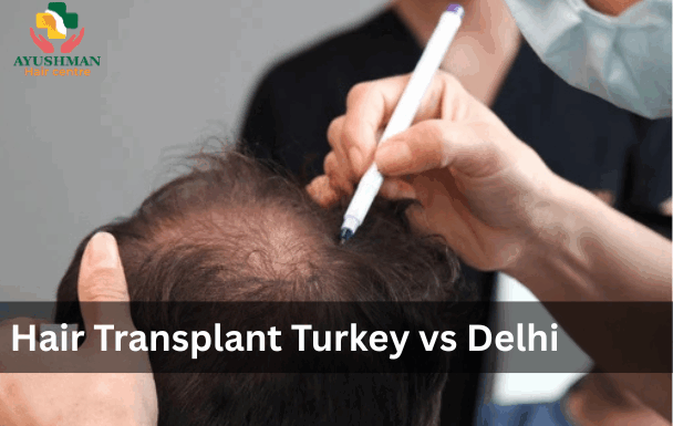Hair Transplant Turkey vs Delhi