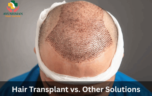 Hair Transplant vs. Other Solutions